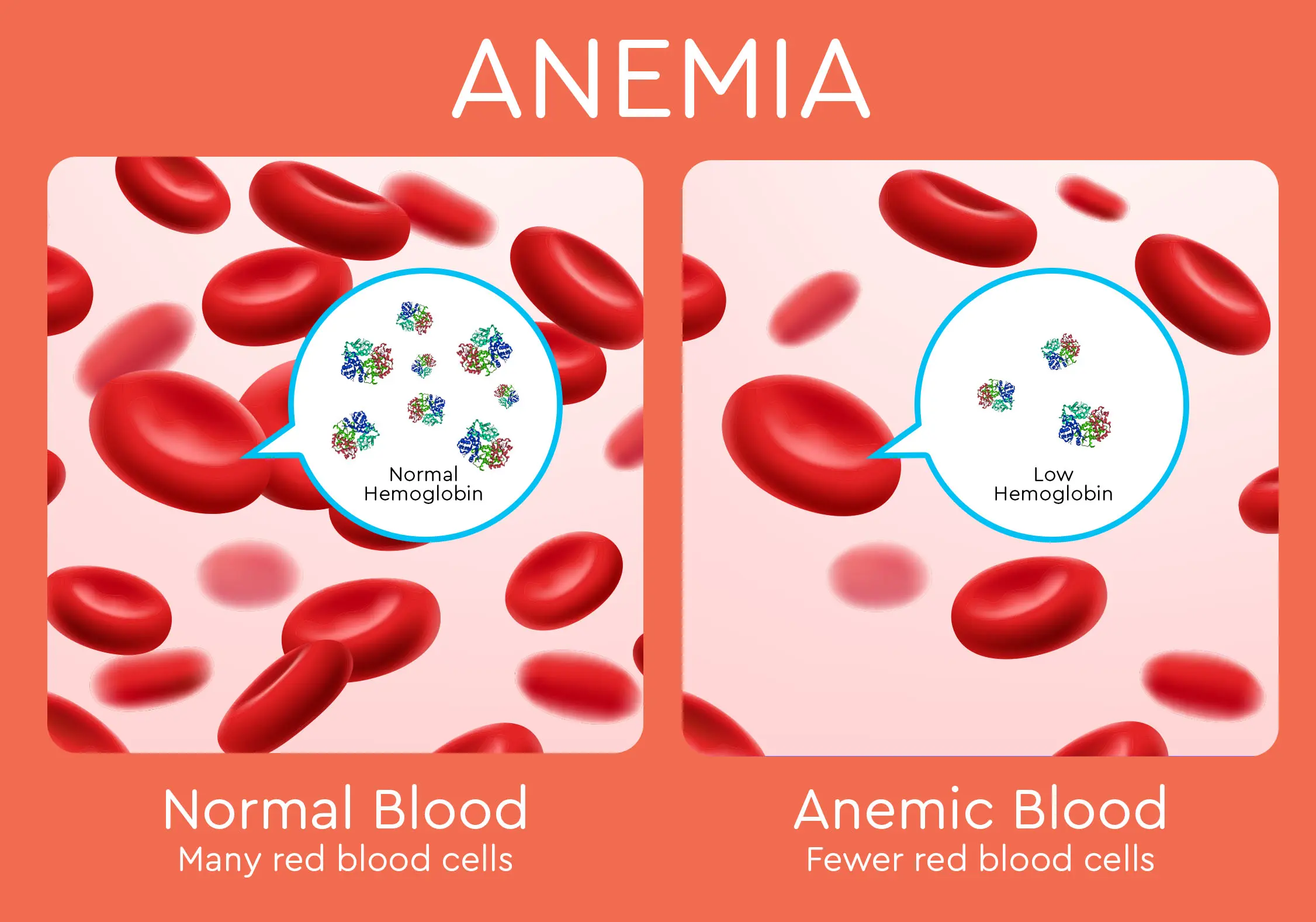 normal blood graphic showing many red blood cells, next to anemic blood graphic showing fewer red blood cells
