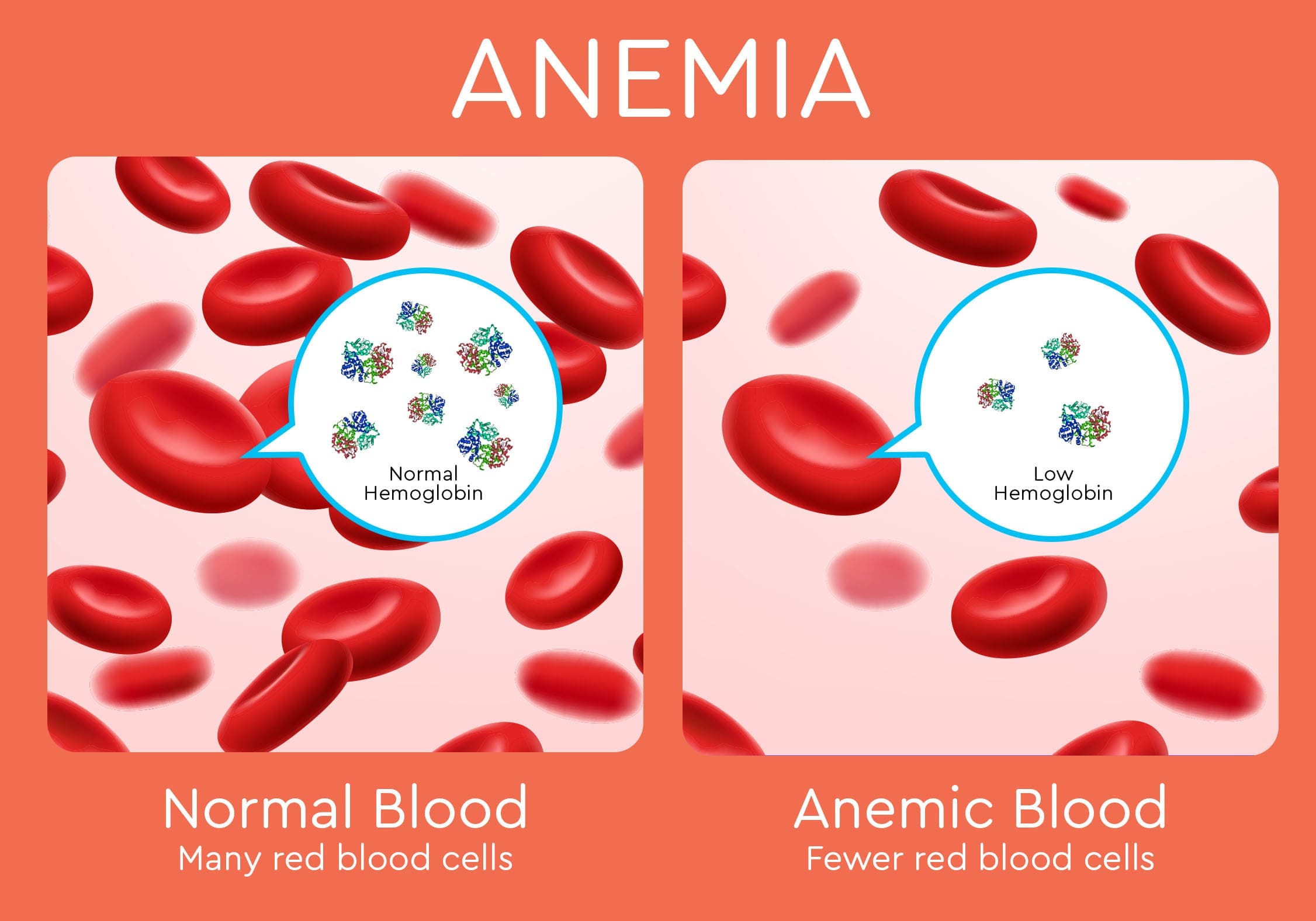 Stages Of Iron Deficiency Anemia