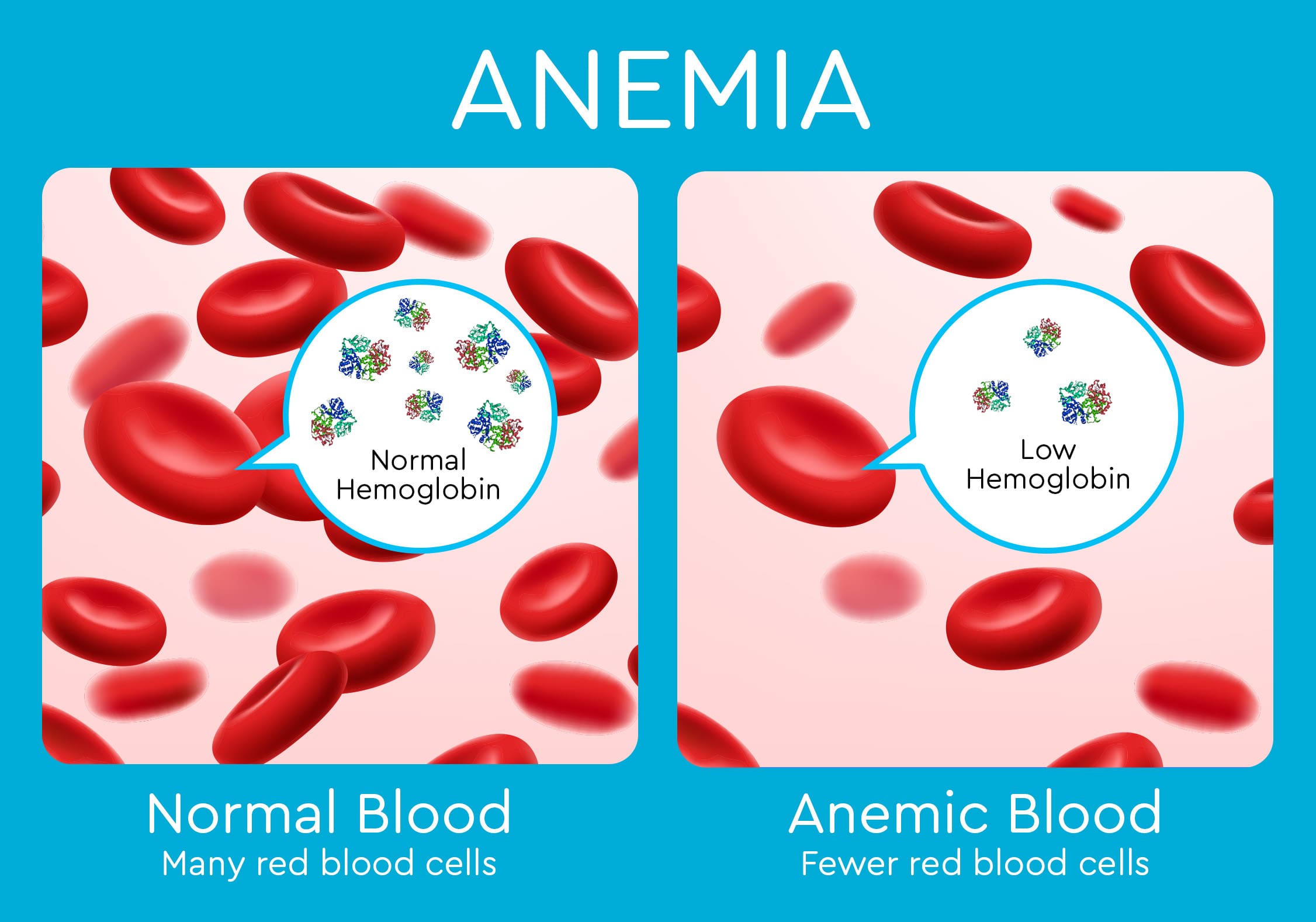 normal blood graphic showing many red blood cells, next to anemic blood graphic showing fewer red blood cells