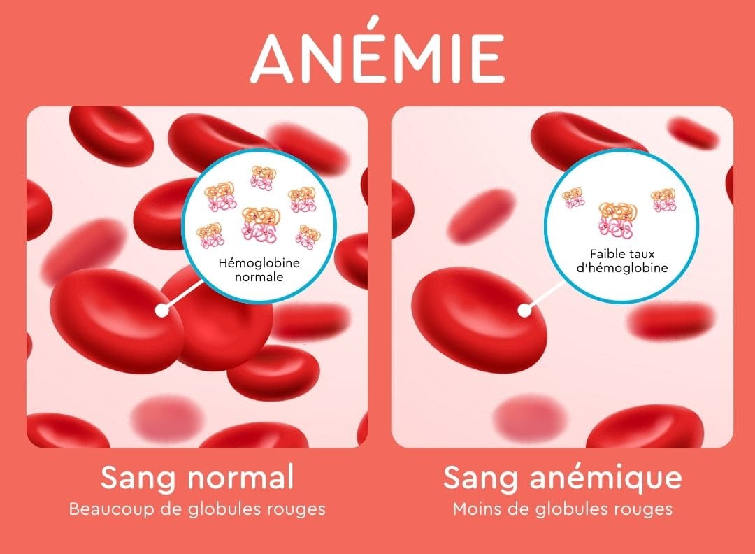graphique de sang normal montrant de nombreux globules rouges, à côté d'un graphique de sang anémique montrant moins de globules rouges