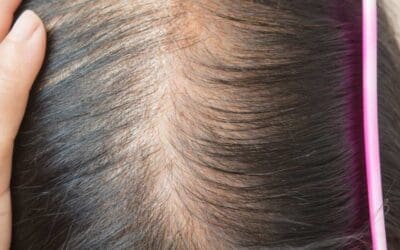 Female Hair Loss: The Low Iron Connection
