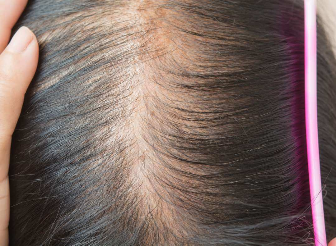 top view of woman's scalp, with thinning hair